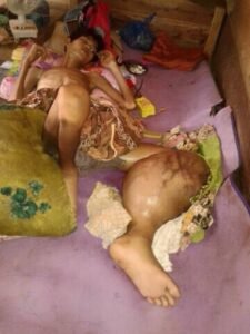 Kisah Penderita Tumor Ganas, Deni : Jangan Potong Kaki Saya