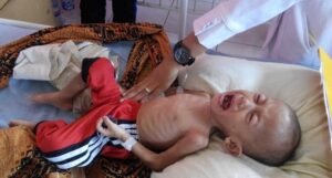 Bocah 18 Bulan di Kabupaten PALI Menderita Gizi Buruk