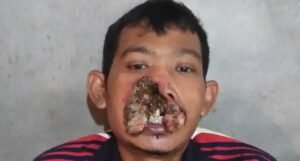 Sering Ngupil dan Mencabut Bulu hidung, Mahmudi Menderita Penyakit Aneh